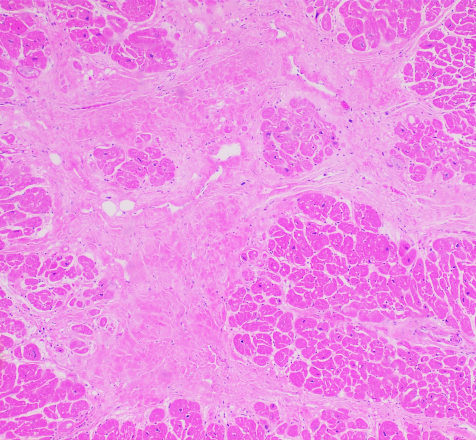 Histopathology of interstitial fibrosis of chronic ischemic heart disease — illustrating heart disease
